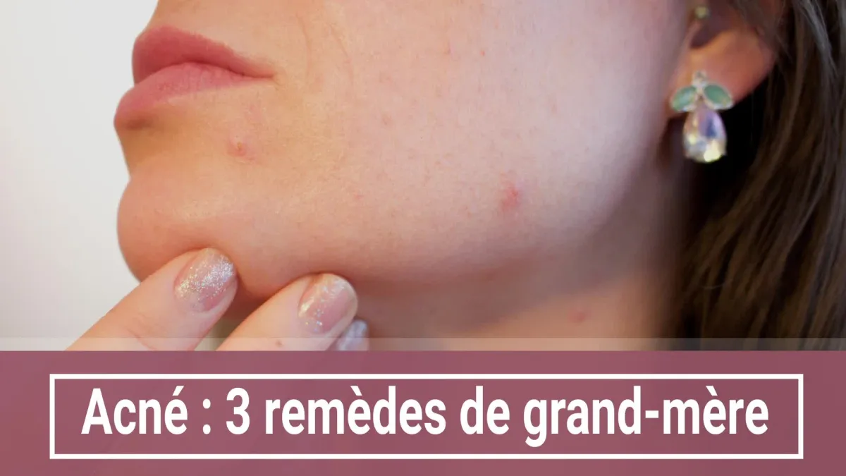 Acné : 3 remèdes de grand-mère