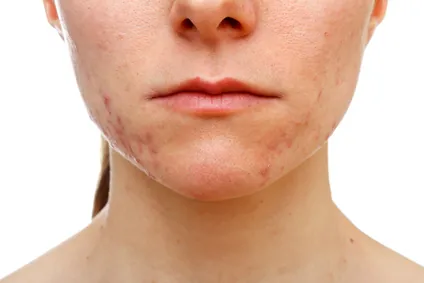 Acné, soin naturel pour le visage