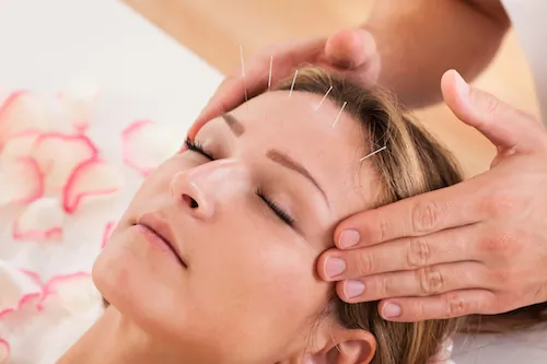 Ménopause : l’acupuncture soulagerait les femmes