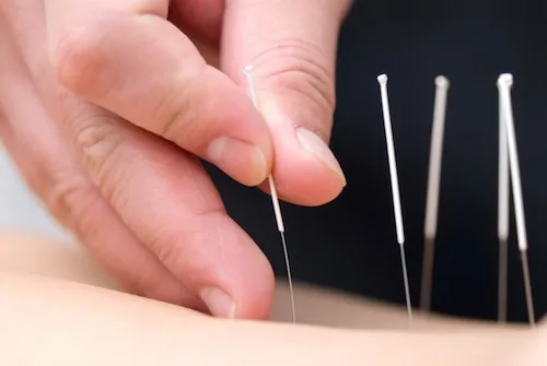 Deux thérapies alternatives pour soigner les douleurs musculaires chroniques