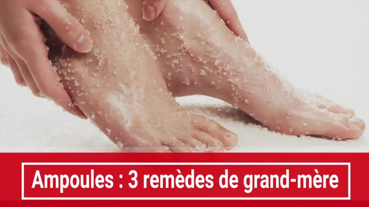 Ampoules : 3 remèdes de grand-mère