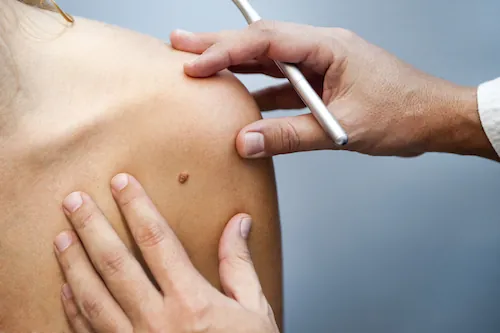 Les personnes rousses plus vulnérables face au cancer de la peau.