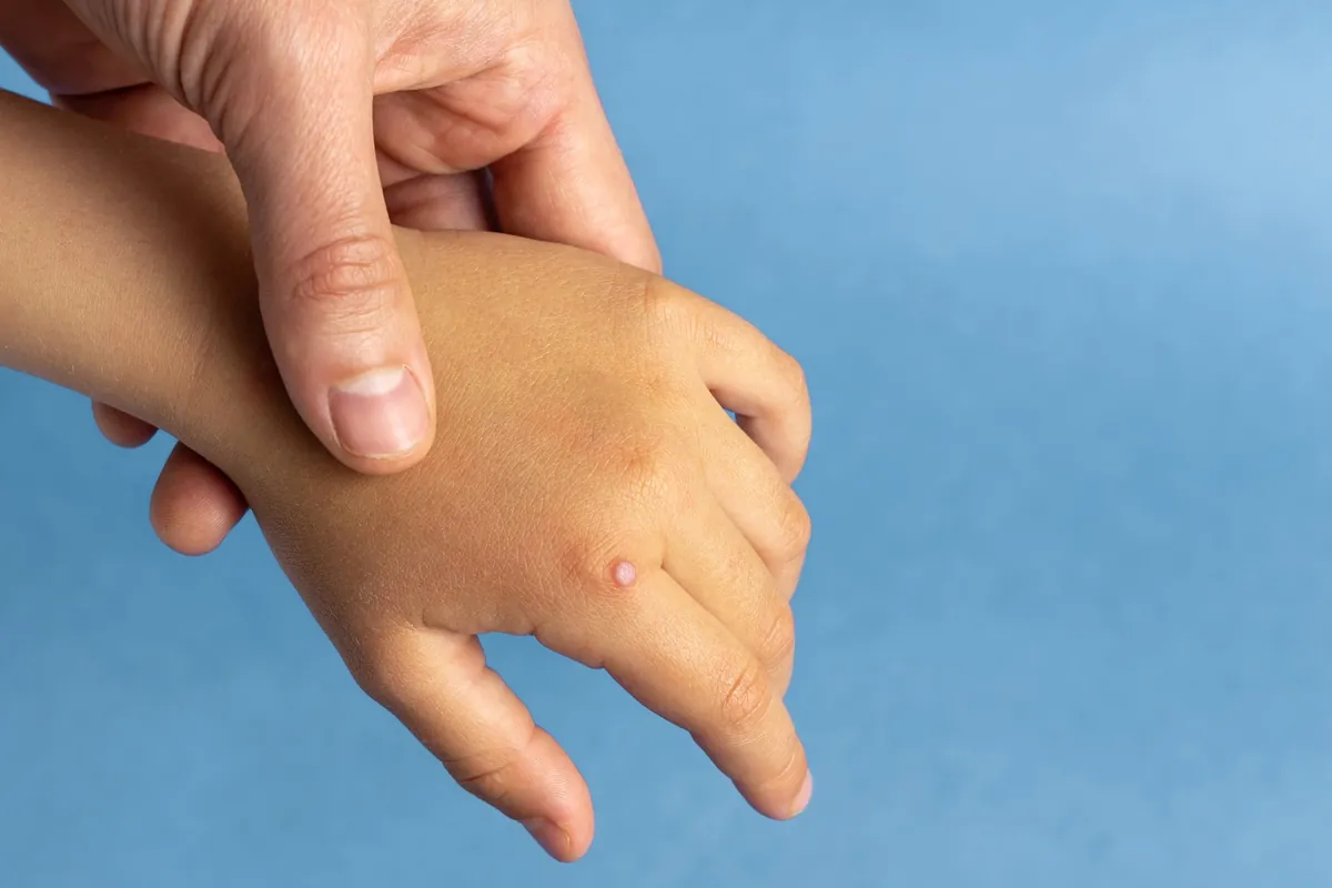 Comment se débarrasser efficacement des verrues sur les mains ?