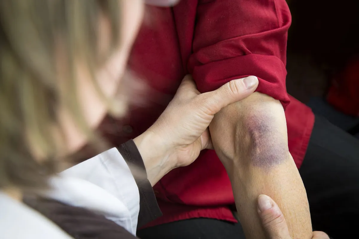 Comment soigner une contusion naturellement ?