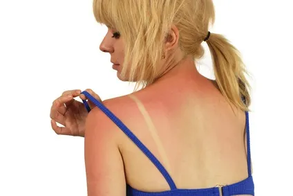 Comment soulager rapidement et naturellement un coup de soleil ?