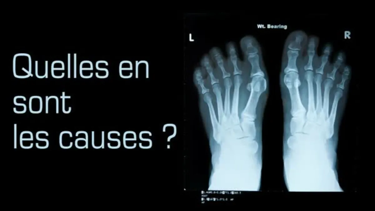 Hallux valgus : symptômes, causes et solutions