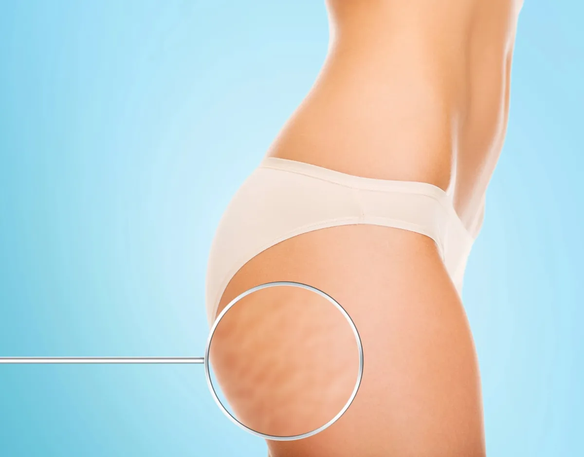 Massage anti-cellulite : les techniques les plus efficaces pour une peau lisse