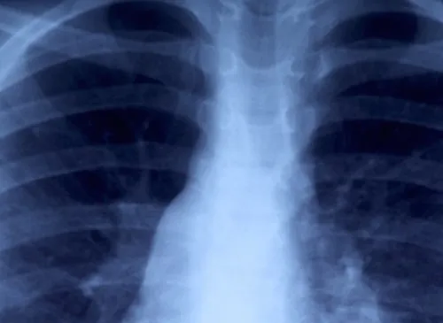 Mucoviscidose : nouvelle technique de reconditionnement des greffons pour permettre encore davantage de greffes pulmonaires