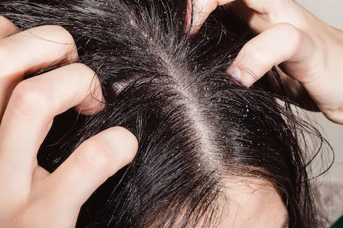 2 solutions naturelles contre les pellicules