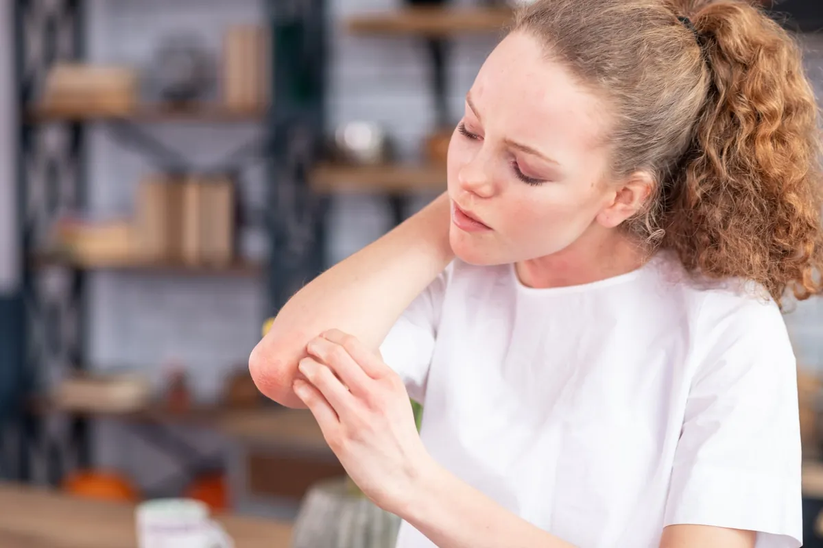 Psoriasis : remèdes naturels pour réduire les symptômes