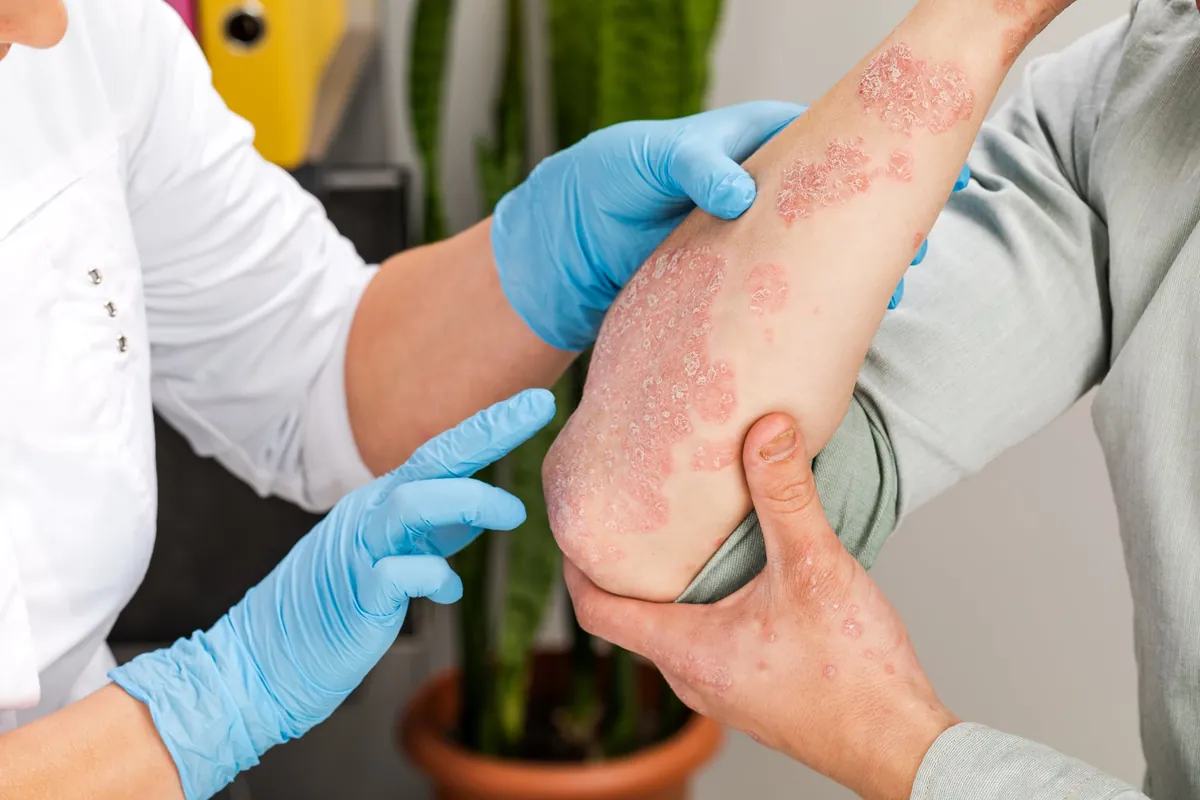 Psoriasis : 4 remèdes de grands-mères