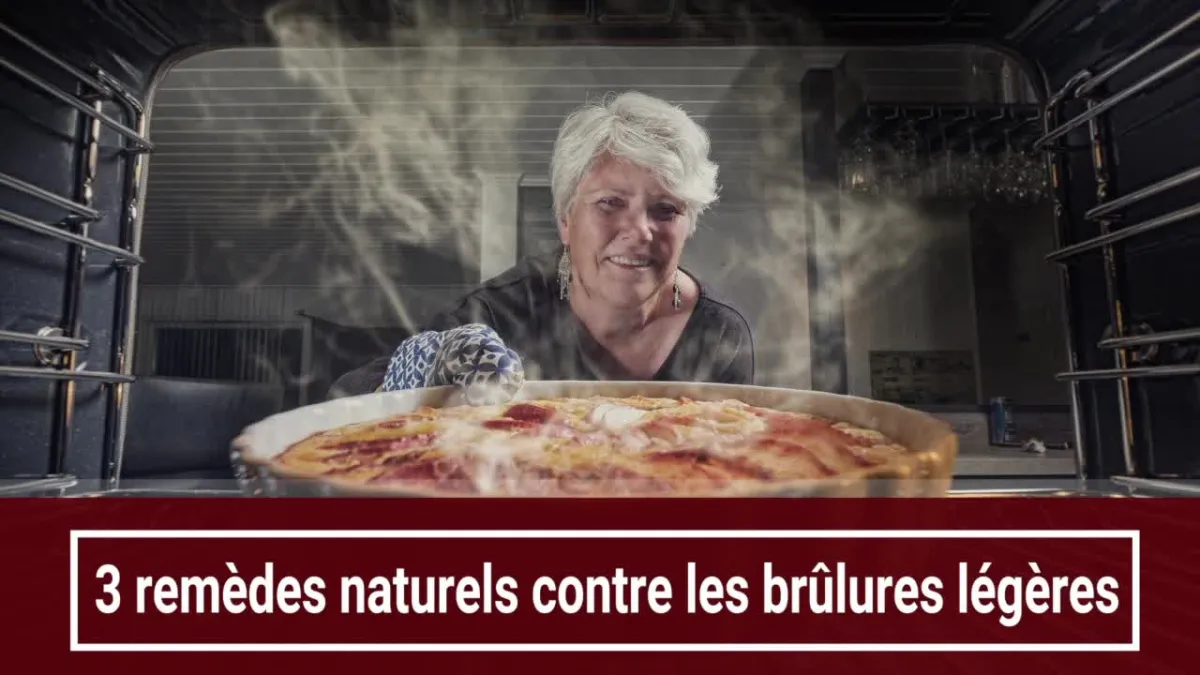 3 remèdes naturels contre les brûlures légères