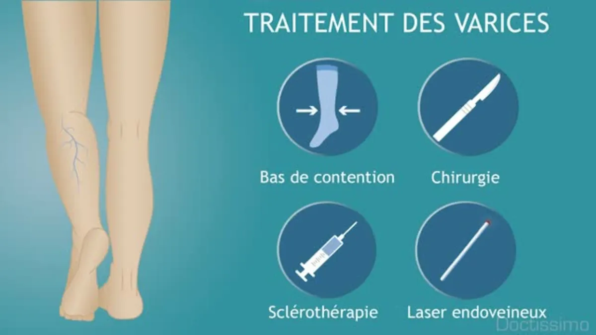 Varices : définition, causes et traitements