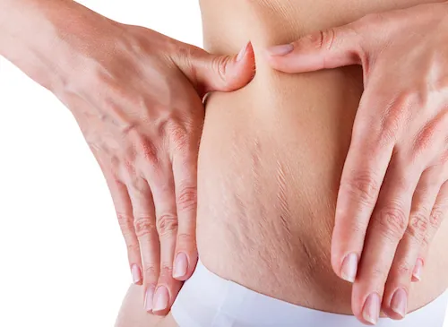 2 solutions naturelles contre les vergetures